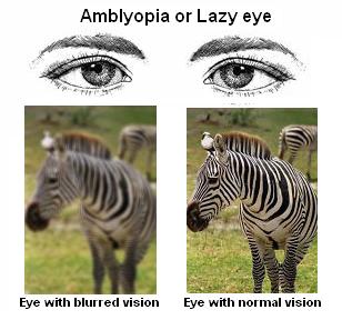 amblyopia-lazyeye.jpg